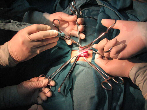phẫu thuật ngoại khoa u xơ tử cung